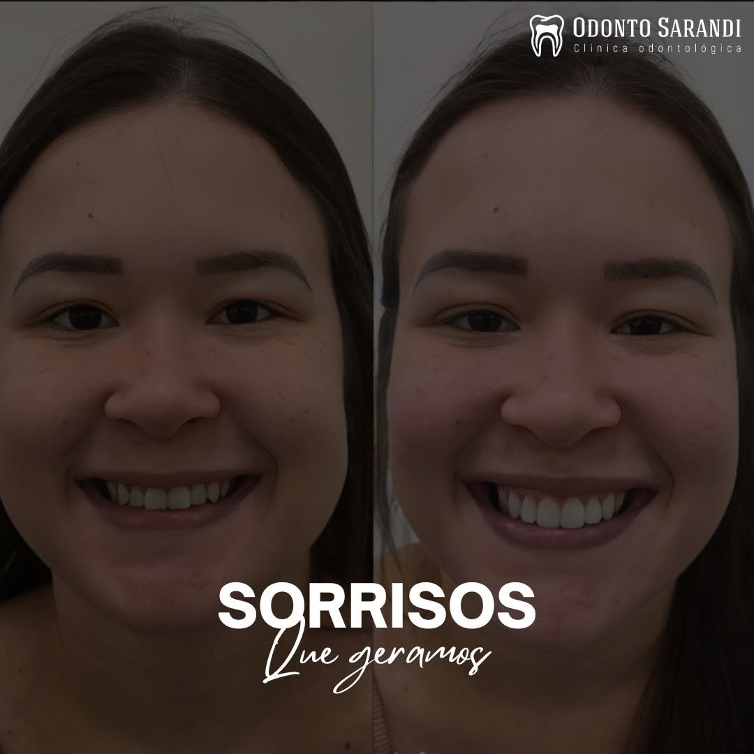 Antes e depois – Sorriso Odonto Sarandi