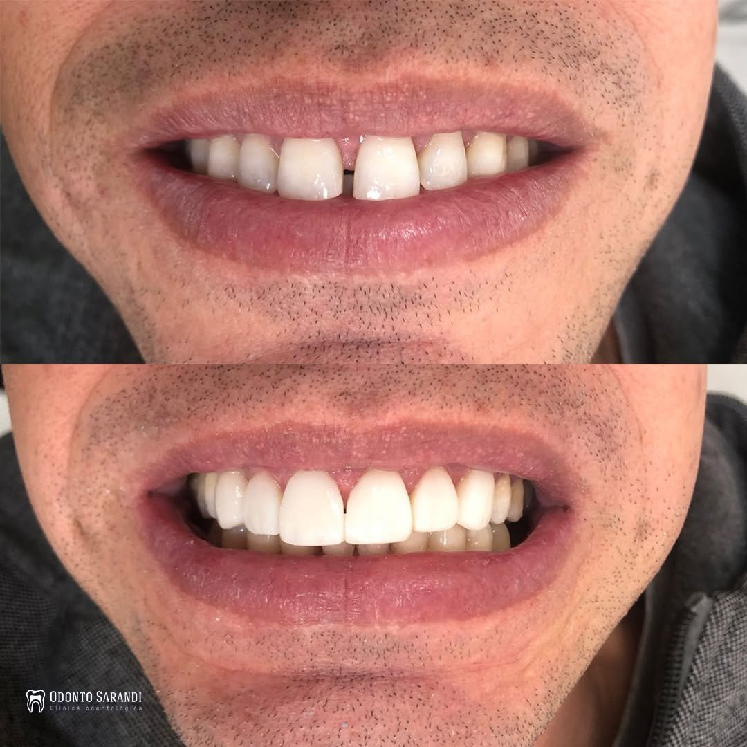 Antes e depois – Lentes de Contato Dental