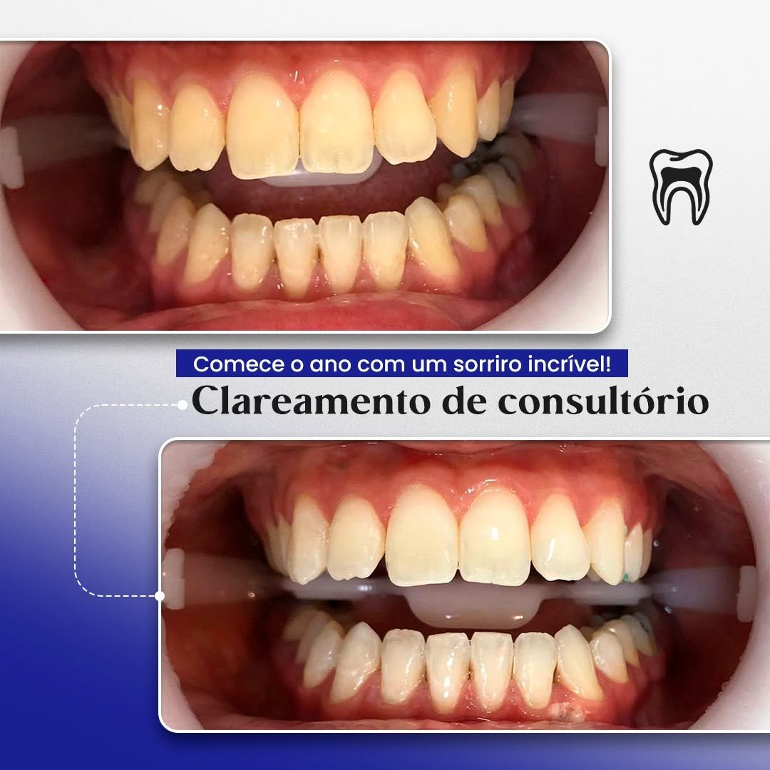 Antes e depois – Clareamento Dental